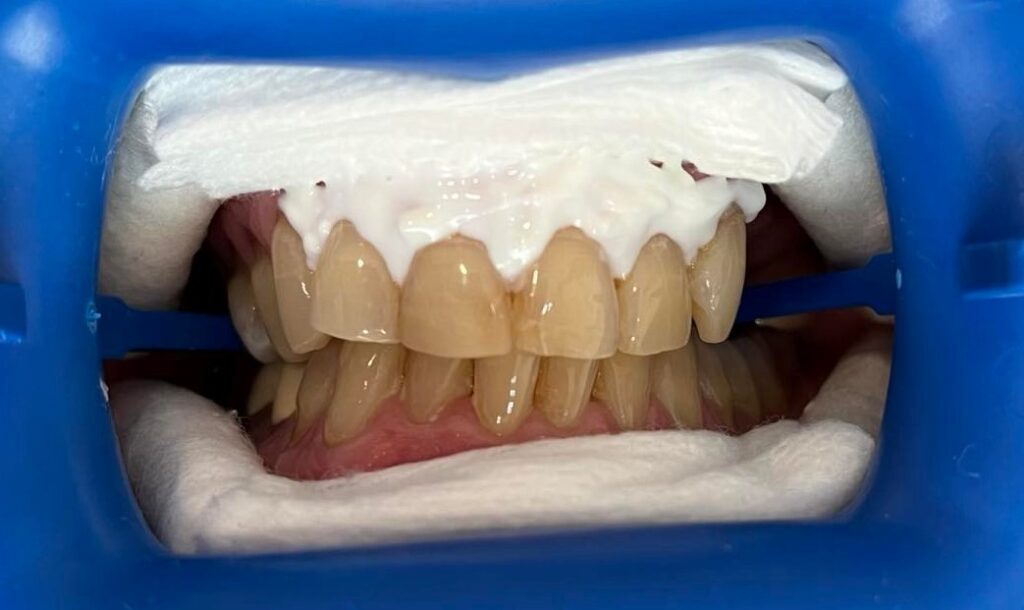 Teeth Whitening Jax Smiles Dentistry