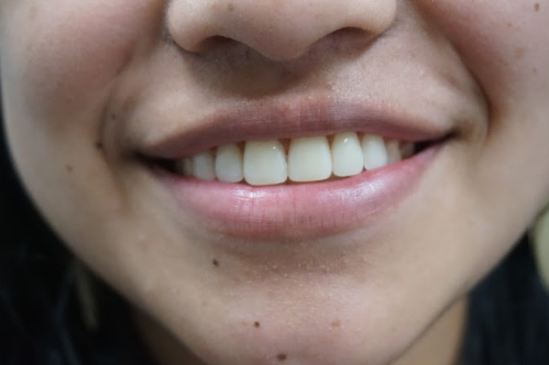 A person with perfectly aligned teeth.