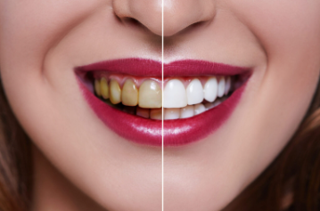 Before and after results of professional teeth whitening in Jacksonville.