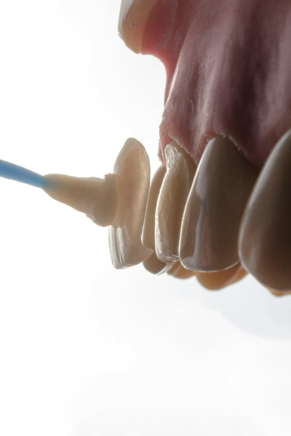 A closeup image of dental veneers being applied on a teeth model